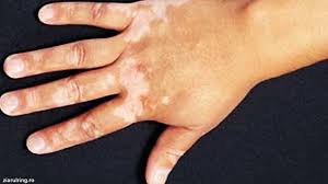 Kami memiliki database lebih dari 122 ribu. Vitiligo Warna Kulit Pudar Menjadi Putih Susu Health Liputan6 Com