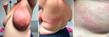 Image result for zoster under breasts