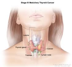 It may also help you to feel less alone. Thyroid Cancer Treatment Adult Pdq Treatment Patient Information Nci Michigan Medicine