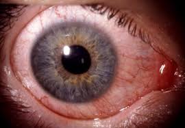 Wenn augen stechen, reiben, jucken, brennen oder schmerzen, tränen sie häufig auch vermehrt und sind gerötet. Bindehauterkrankungen Auge Online