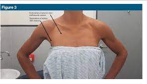 There is a large array of exercises available to focus on the pectoralis muscle including the four major regions of upper, lower, middle and outer. Pdf Pectoralis Major Rupture In An Active Female Semantic Scholar