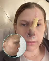 I Melted My Nose Off