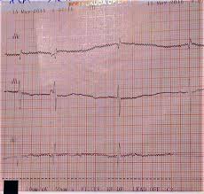 Atrioventricular block // msd manual. Bloc Atrioventricular Congenital La Nou NÄƒscut Din MamÄƒ Cu Lupus Eritematos Sistemic Prezentare De Caz