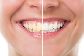 Chino aesthetic dental is here to provide each patient with custom outstanding dental care. Chino Cosmetic Dentist Teeth Whitening Gavrila Dental