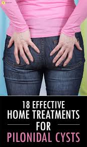 13 Pilonidal Cyst Home Treatments Pilonidal Cyst Cysts Home Treatment