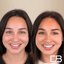 Can You Get Composite Bonding