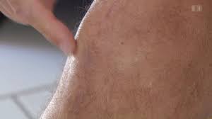 Korper Geist Arthrofibrose Das Unsichtbare Wuchern Nach Der Knieoperation Puls Srf