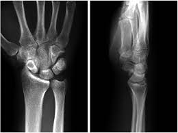 Image result for Scapholunate Dislocation