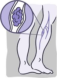 La enfermedad tormboembólica venosa es la tercera causa de mortalidad vascular. Como Detectar Y Prevenir La Trombosis Venosa Profunda Los Institutos Nacionales De Salud