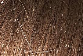 Chemicals for getting rid of head lice are ineffective against killing head lice and removing nits. Lice Pictures Of What Head Lice Look Like