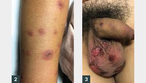 Image result for Erythema Multiforme Major