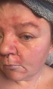 What skin care advice can you give after stopping dove sensitive skin bar  soap?