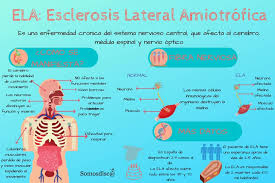 La definición de enfermedad según la organización mundial de la salud (oms), es la de «alteración o desviación del estado fisiológico en una o varias partes del cuerpo. Somosdisca Diamundialdelaela Infografia Ela Facebook