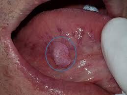 Image result for papillomavirus tongue)