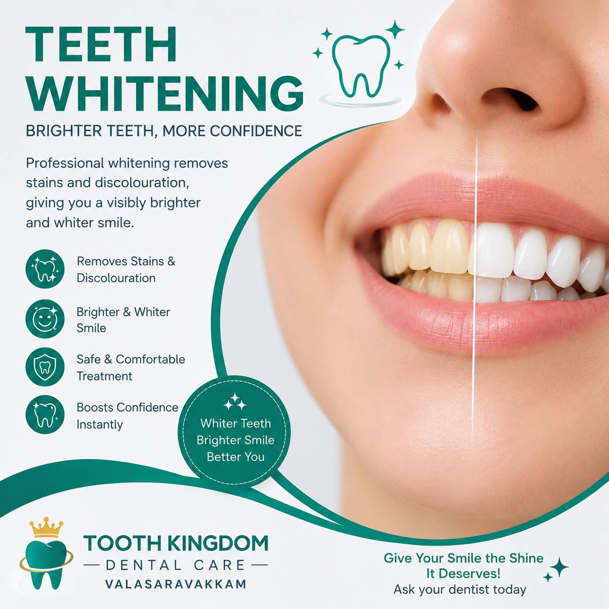 Teeth Whitening