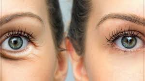Goz Alti Torbalari Nasil Gecer Undereye Bumps Under Eyes Under Eye Wrinkles