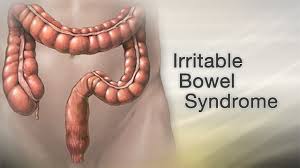 A persistent change in your bowel habits, including diarrhea or constipation or a change in the consistency of your stool rectal bleeding or blood in your stool Irritable Bowel Syndrome Information Mount Sinai New York