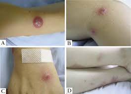 Image result for Pathergy