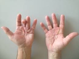 Trigger finger tanda dan gejala penyebab cara mengobati cara mencegah. Gambar Tangan Manusia Beserta Fungsi Setiap Bagiannya Hello Sehat
