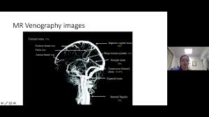 Severe dehydration after competitive sport had induced cvst. Webinar Cvst Cerebral Venous Sinus Thrombosis With Dr Michelle Lavin Youtube