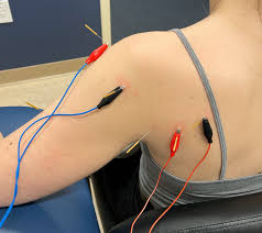 Dry Needling Miami