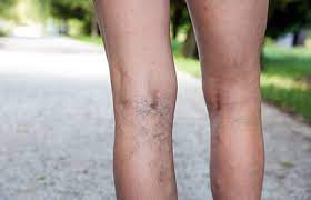 Leg Veins Why They Appear And How Dermatologists Treat Them