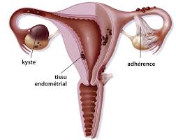 Endometriose is een gynaecologische aandoening waarbij cellen van het baarmoederslijmvlies (endometrium), die normaal de binnenkant van de baarmoeder bekleden. Accompagnement Naturopathique De L Endometriose Laurence Guillon Naturopathe