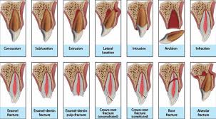 Image result for Tooth Avulsion