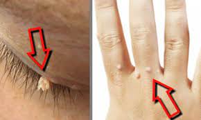 elimina las verrugas de tu cuerpo con estos 6 eficaces remedios mejor con salud eliminar las verrugas verrugas eliminar berrugas