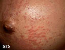 Image result for pruritic urticarial papules and plaques of pregnancy