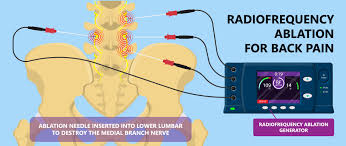 Image result for Radiofrequency Surgery