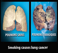 The type of surgery will depend on the extent of the. Who Smoking Causes Lung Cancer