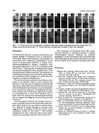 The top online printing company for all your printing needs. Atrioventricular Block Complicating Acute Streptococcal Tonsillitis Abstract Europe Pmc
