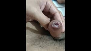 Syphilis (sexual transmitted disease) made my dick looking swallen. look at  it