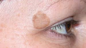 Webmd explains what hyperpigmentation is and what you can do about it. Sunspots On Skin Causes And Treatment