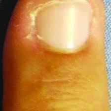 Uñas de plummer depegamiento distal de las uñas, son raras de ver, cuando se ven están en el 4° dedo. Pdf Alteraciones Ungueales Como Marcador De Enfermedad Sistemica