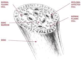 It's highest if you're over age 65. Multiple Myeloma Overview Cancer Council Victoria