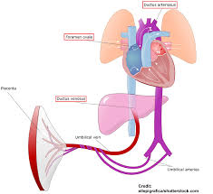 Image result for Delayed Transition from Fetal Circulation