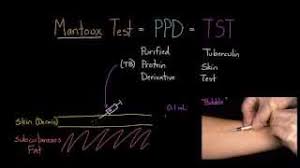 .vaccination policies and progression in vaccination trials including bcg and new tb vaccines. Mantoux Test Aka Ppd Or Tst Youtube