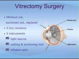Pin On Retinal Tears Eye Health