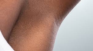 Burns, permanent changes to your skin color, and scars can occur. Laser Hair Removal Michigan Detroit Laser Hair Removal