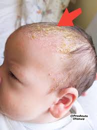 Image result for yellow scabs on the face in children