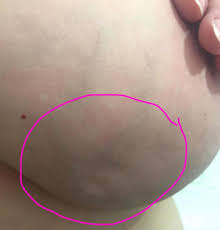 No Habia Notado Ningun Bulto Hasta Que Levanto Los Brazos Y Los Medicos Vieron Esto
