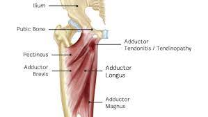 This diagram with labels depicts and explains the details of groin muscles diagram. Adductor Tendinopathy An Athlete S Struggle With Groin Pain Diversified Integrated Sports Clinicdiversified Integrated Sports Clinic