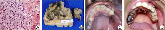 Abstract osteosarcoma of the jaw is rare considering that its incidence varies between 5 % and 13 % of total osteosarcomas. Https Www Ajodo Org Article S0889 5406 11 00242 3 Pdf