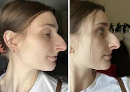 People Can't Believe How This Woman Looks After Getting A $11k Nose Job