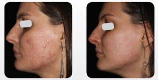 Энергетические устройства для лечения рубцов постакне: Рекомендации  международного консенсуса 2022