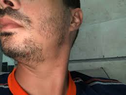 You can use commercial bleach, which you can purchase at any drug store, or try natural remedies. Massive Patch 10 Days Growth Is This Hopeless Beardadvice
