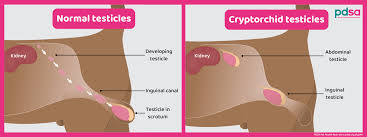 Image result for Undescended Testicle