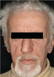 Is a form of sun damage. Pdf Unilateral Favre Racouchot Disease Evidence For The Etiological Role Of Chronic Solar Damage Semantic Scholar